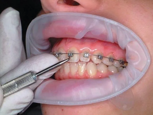 A close-up of a person patient having an adjustment of their braces to help straightened their teeth.