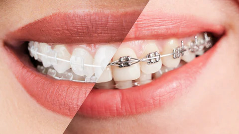 Close-up of a woman’s smile before and after braces, showing clear improvement