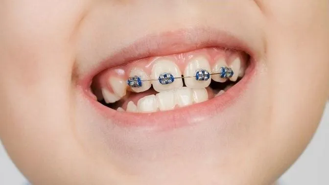 A young boy showing braces on his teeths is an great example of early orthodontic treatment being used. 