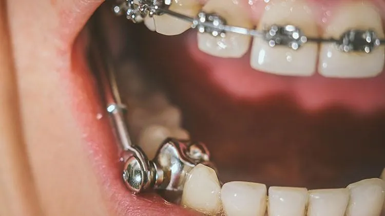 Close-up of teeth with braces and telescopic appliance for dental alignment.