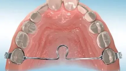 Illustration of a dental palate expander with metal bands and adjustment mechanism.