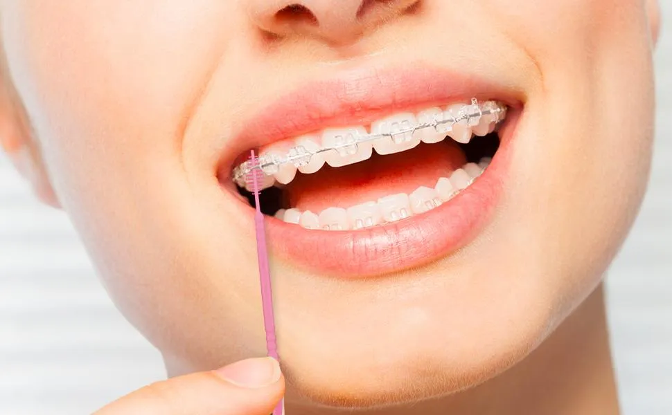 A woman with clear ceramic braces smiles while holding a toothbrush pick, promoting oral care.