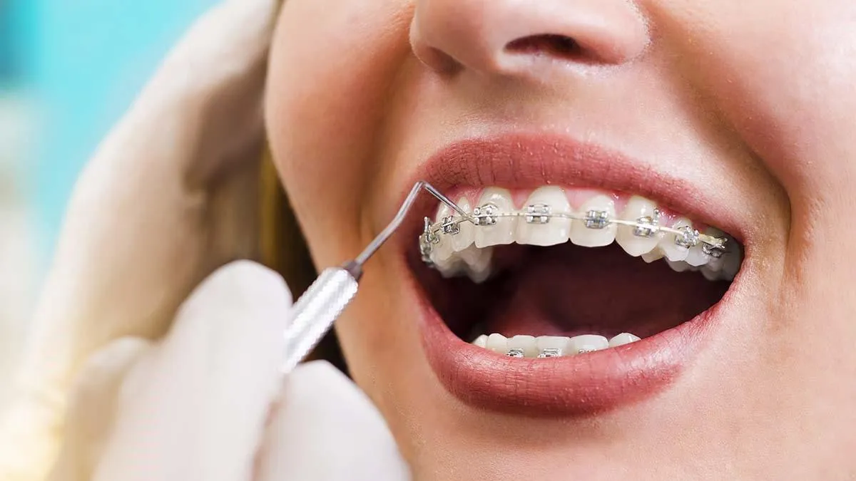 Close-up of a person with braces smiling during a dental check-up.