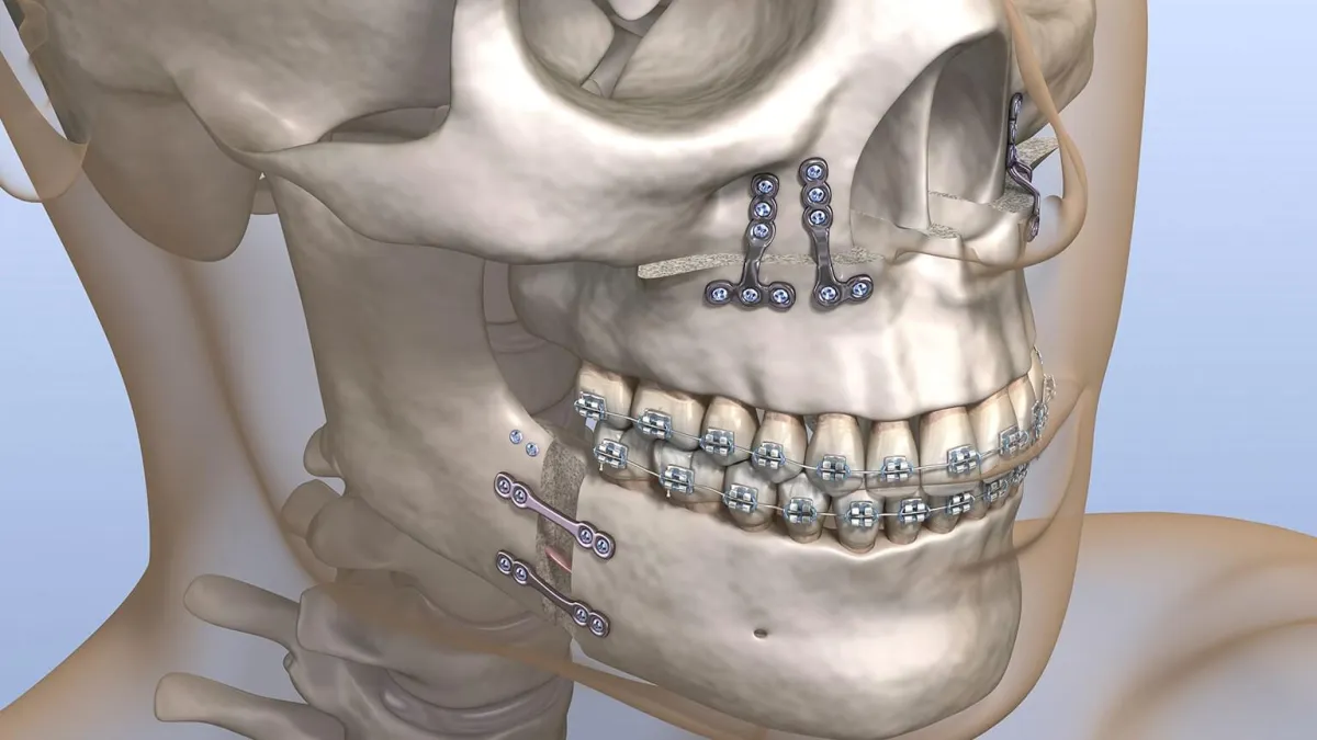 3D illustration of a skull with jaw reconstruction and dental braces.