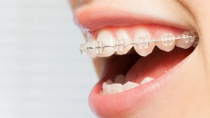 A close-up of a woman smiling with clear ceramic braces.