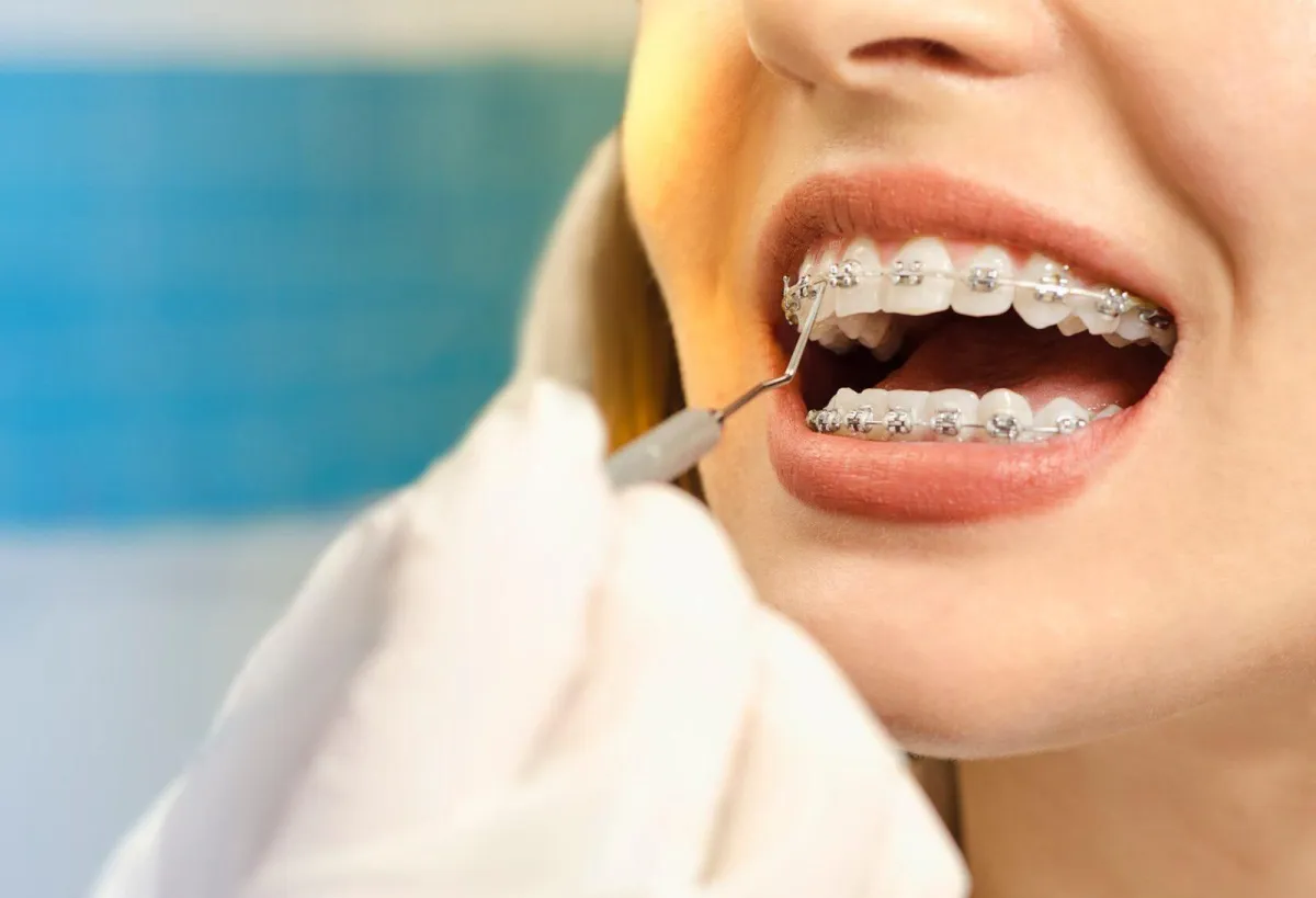 Close-up of a person with metal braces having their teeth examined by a professional.