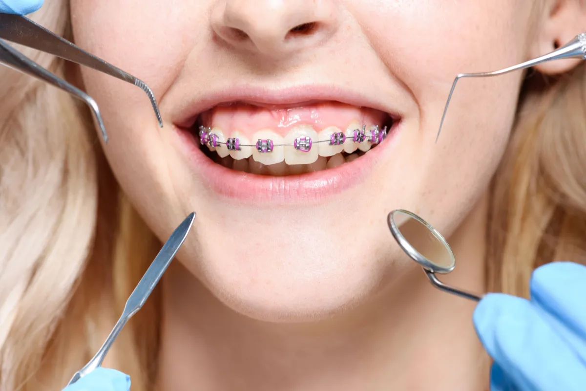Close-up of a person with purple braces, surrounded by orhtodontia tools during a checkup