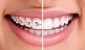A woman close up smile with half the image with braces on one and half the image post treatment with excellent smile.  