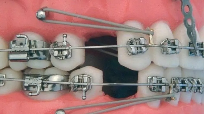 Close-up of a dental model with metal braces, brackets, and attachments on teeth
