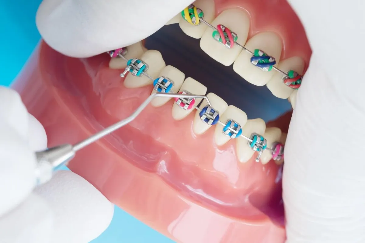Dental model with braces and colorful bands, being examined with a tool on lower teeth