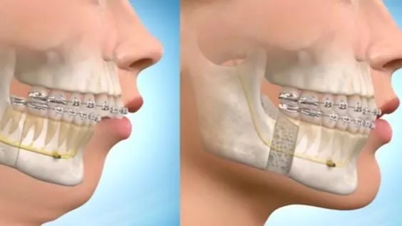 Comparison of two faces: one with perfect braces, one with imperfect teeth