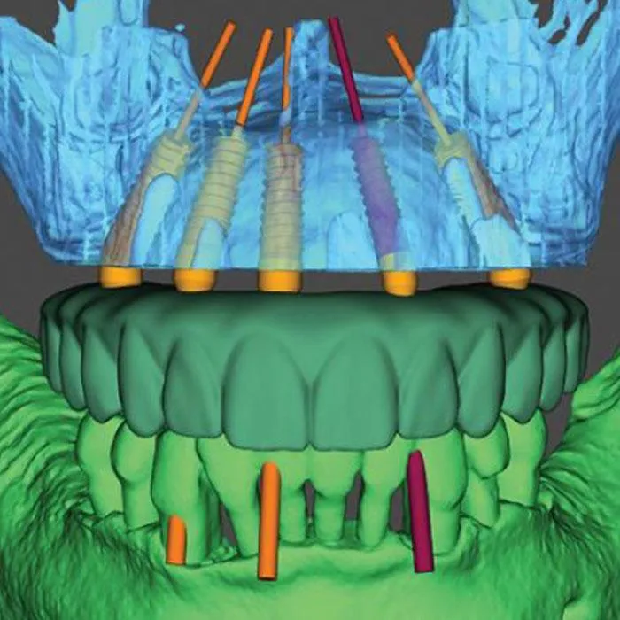 All-On-X, All-On-6, All-On-4, Full Arch Dental Implants at Dental Crown in an Hour