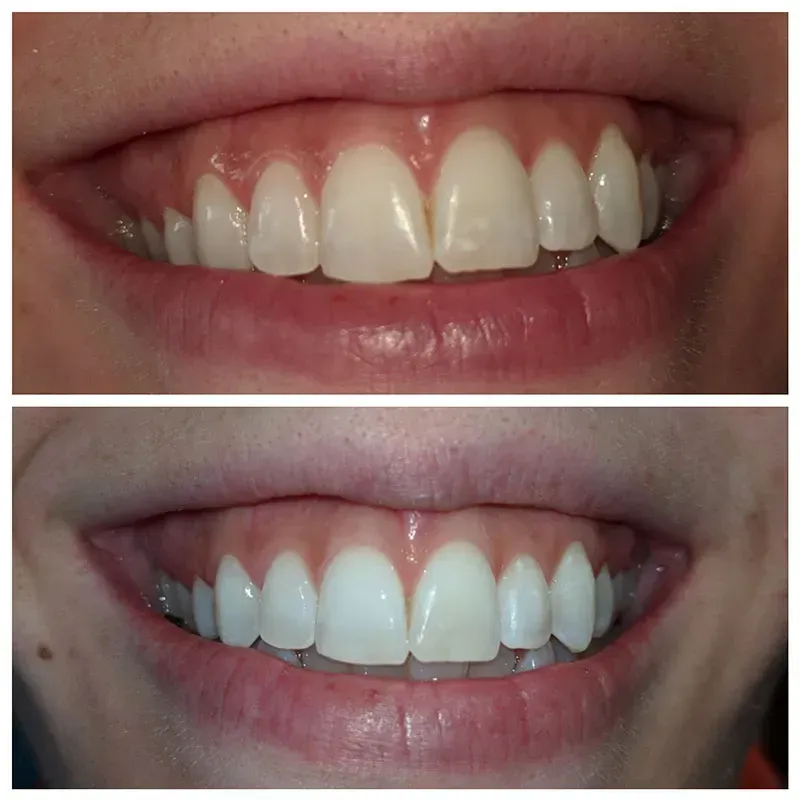 teeth whitening fast low cost