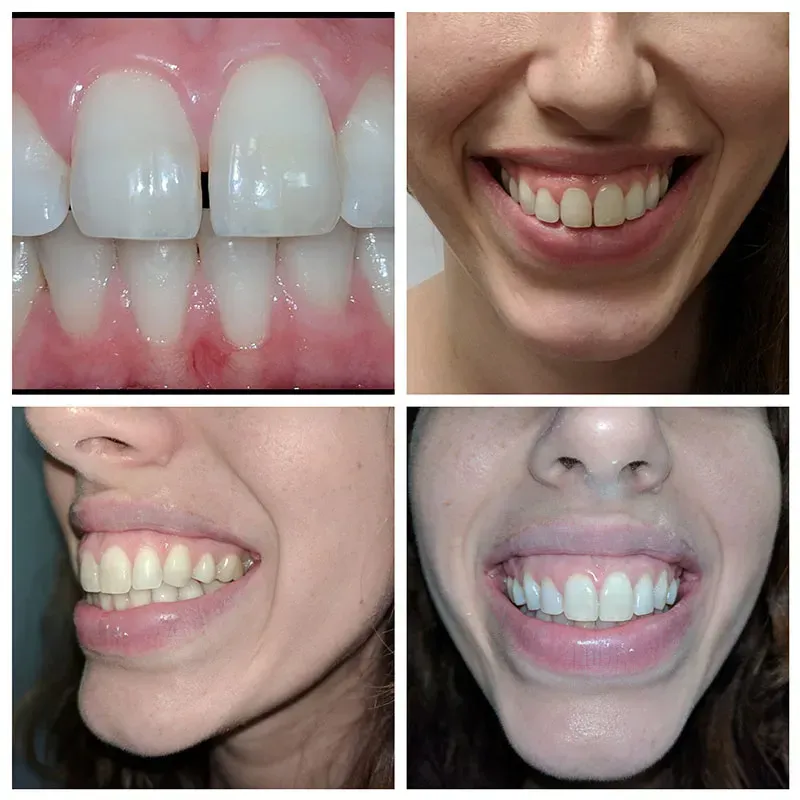 Teeth Whitening before and after Image