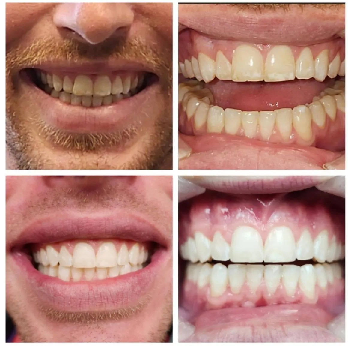 Teeth Whitening Service in Burlington, NC