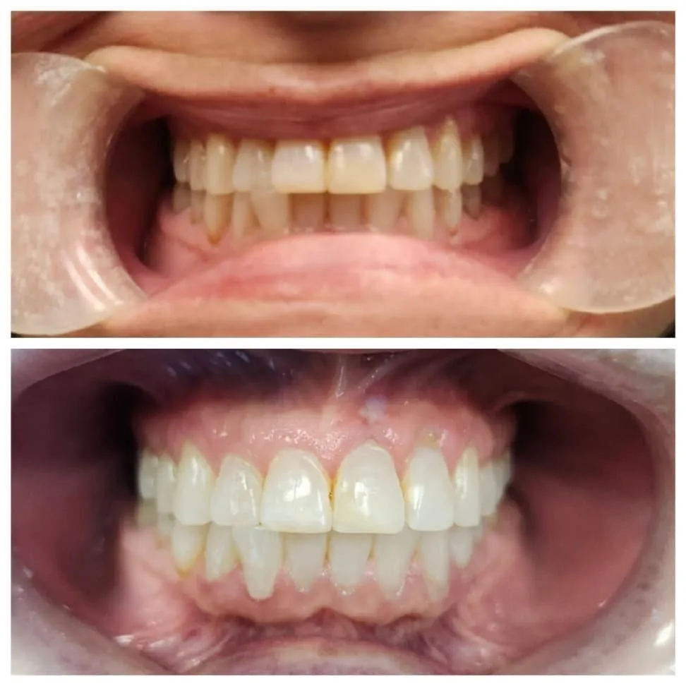 Teeth Whitening before and after Image