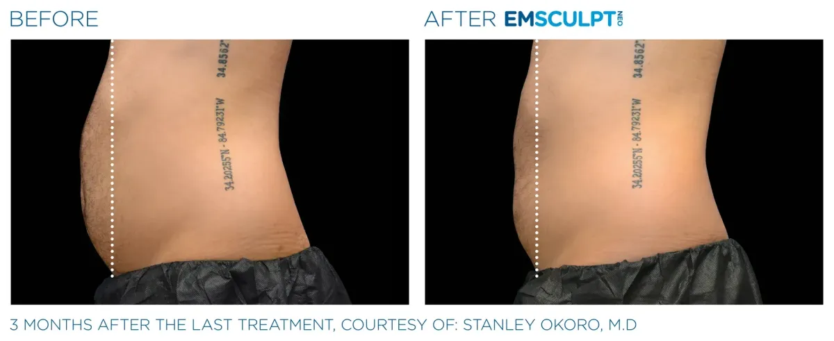 Emsculpt Neo- Body Contouring Gadget- Hits Akron Med Spa
