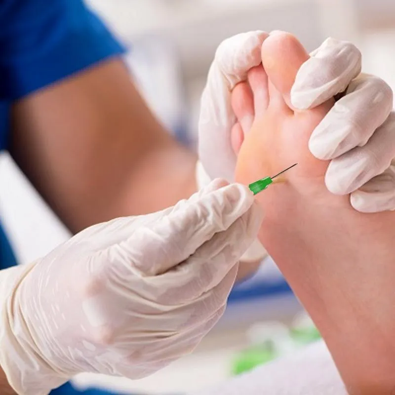 Verruca Needling 