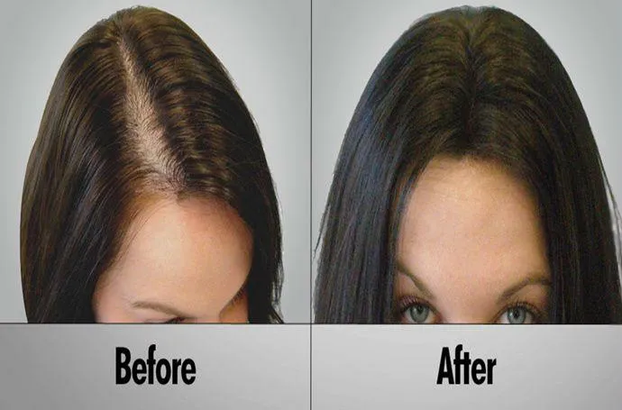 Hair Fortin hair loss formula