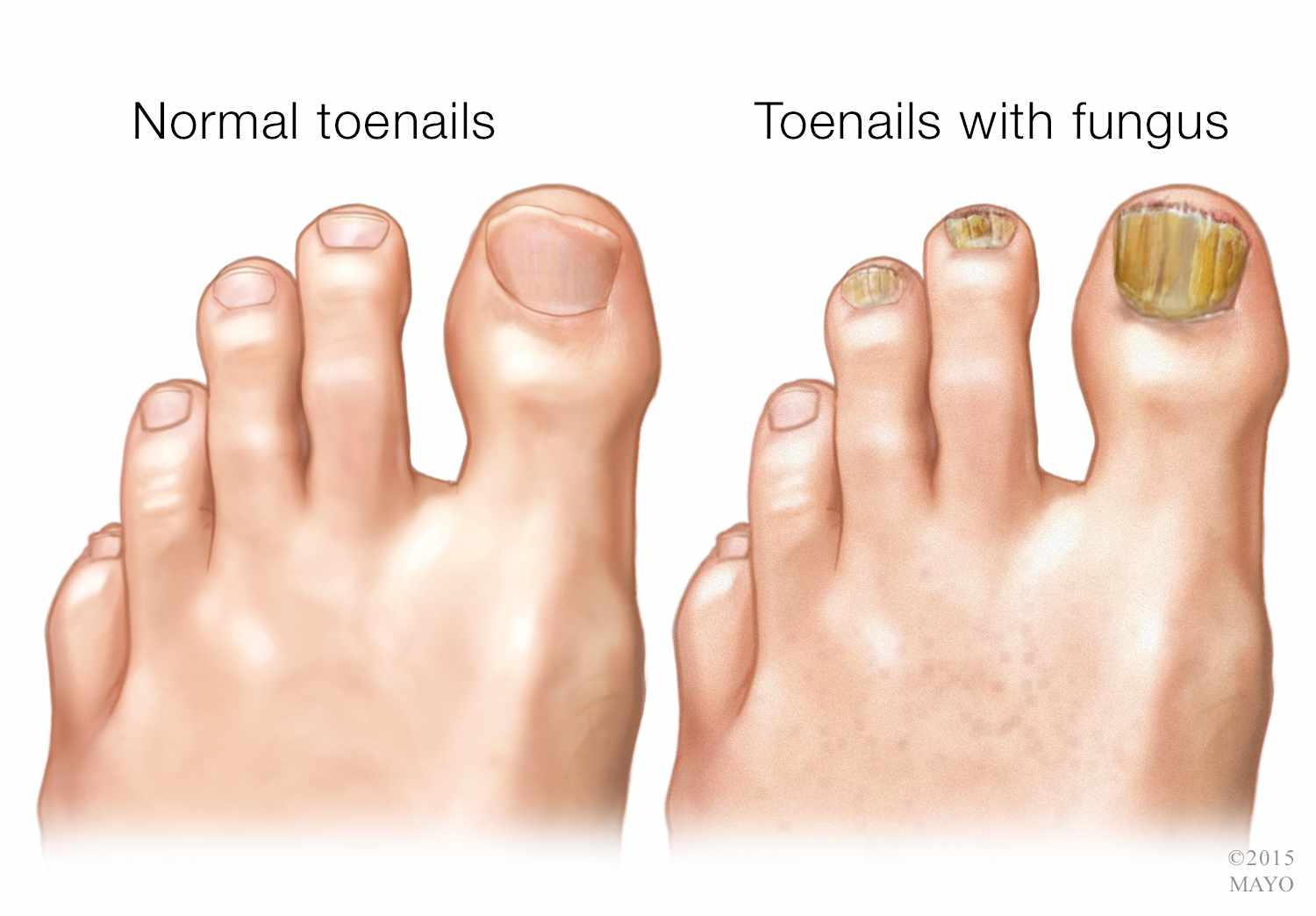 toenails fungus