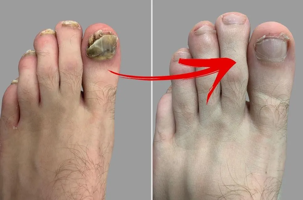 Clavusin toenails fungus