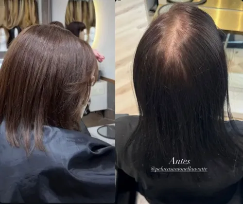 Aumentador capilar para alopecia femenina – integración perfecta con cabello propio