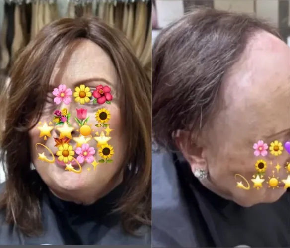 Antes y después con prótesis capilar de volumen – solución estética para alopecia avanzada