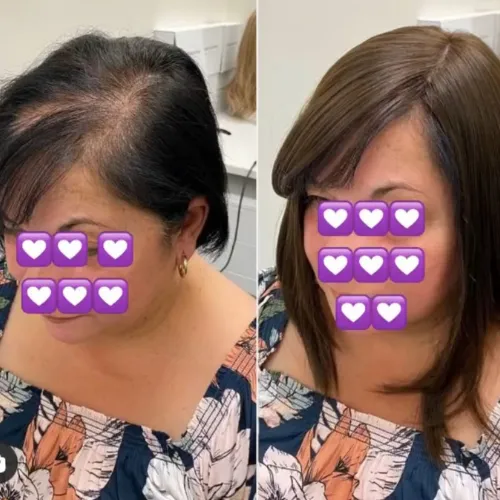 Antes y después con prótesis capilar de integración – resultado natural en Pelucas Avatte