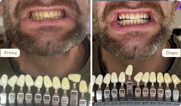Before and After