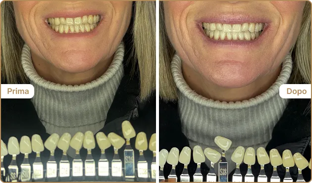 Before and After