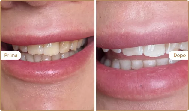 Before and After