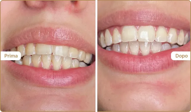 Before and After