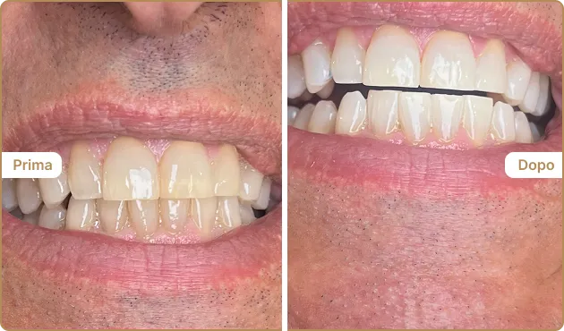 Before and After