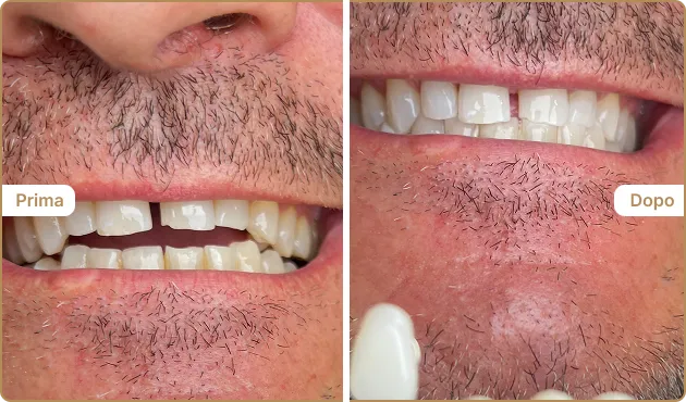 Before and After