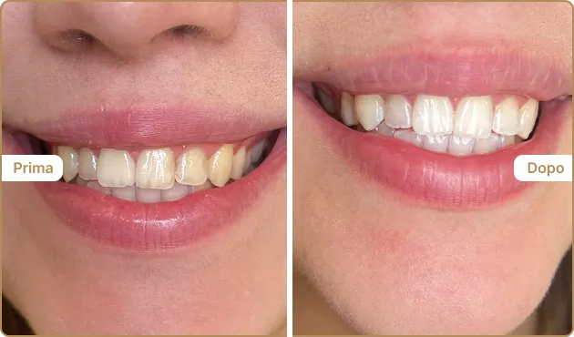 Before and After