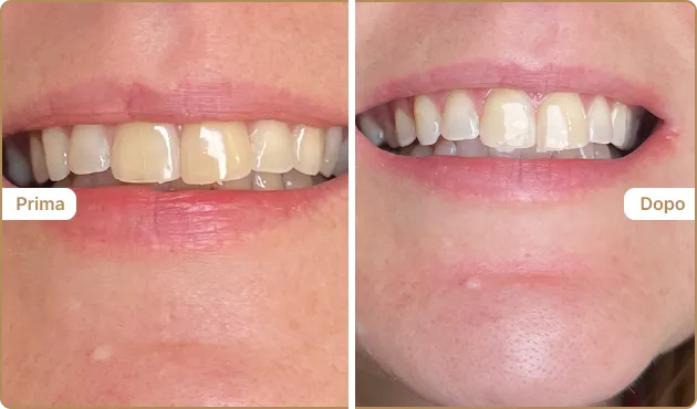Before and After