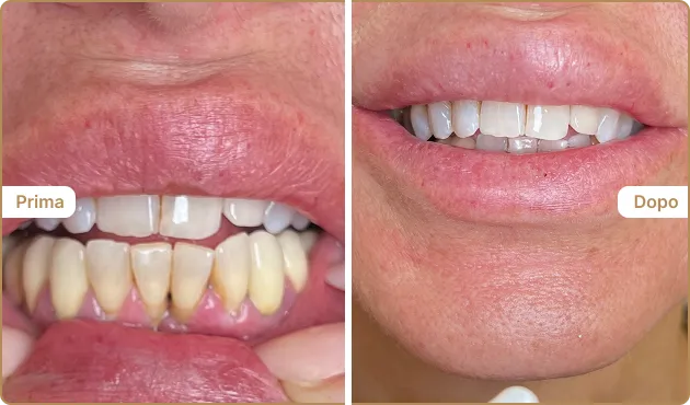 Before and After