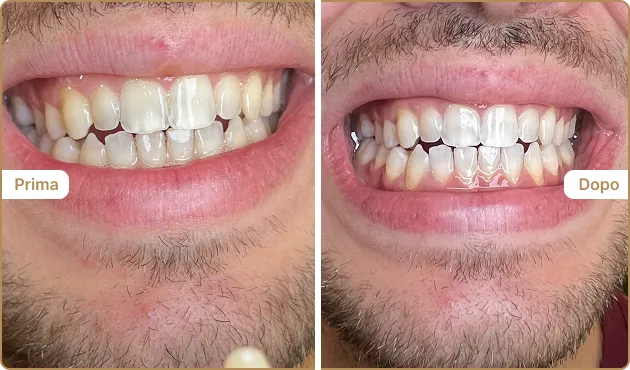 Before and After