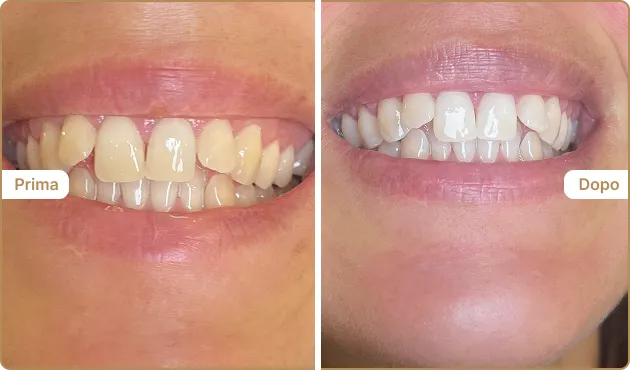 Before and After