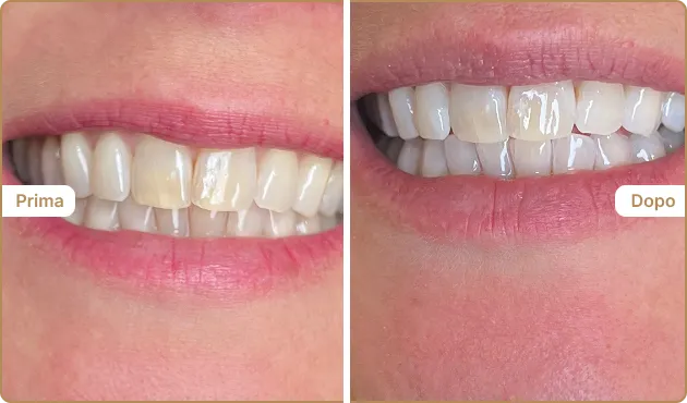 Before and After