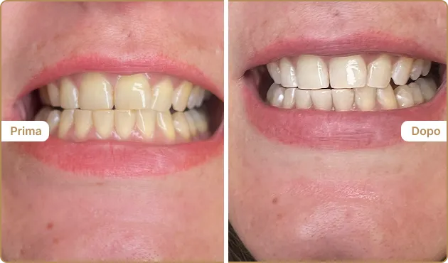 Before and After