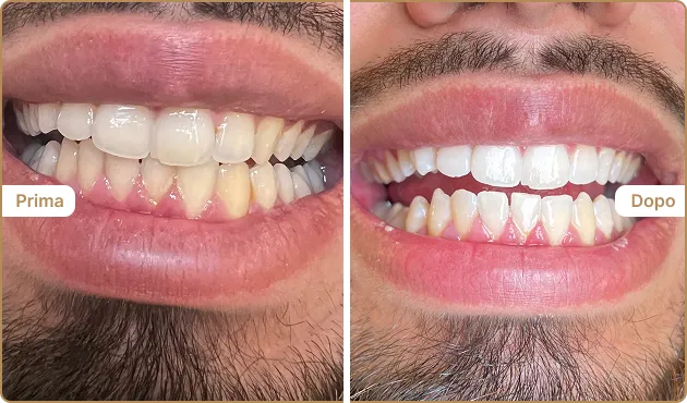 Before and After