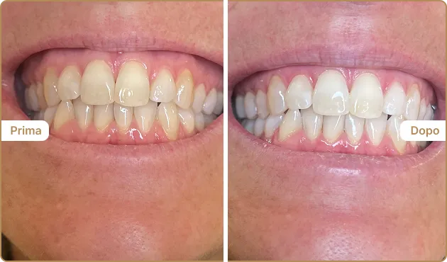 Before and After