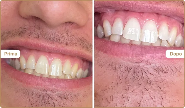Before and After