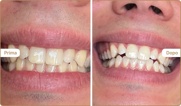 Before and After