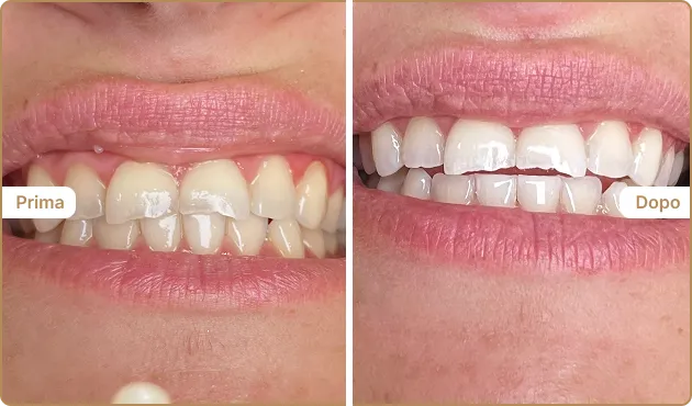 Before and After
