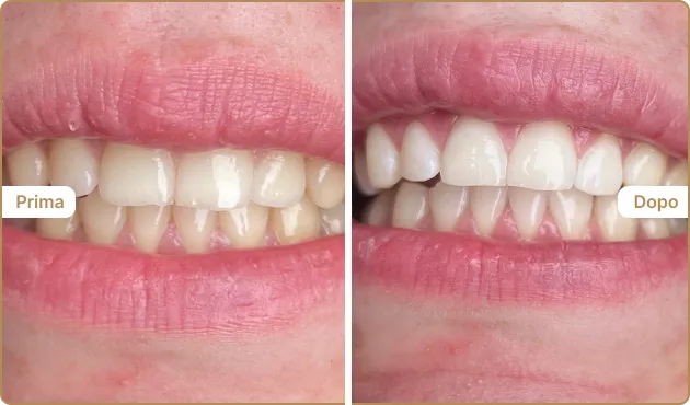 Before and After