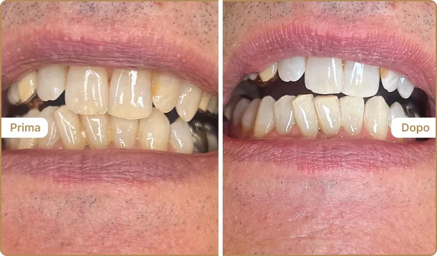 Before and After
