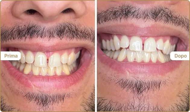 Before and After