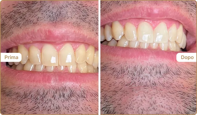 Before and After